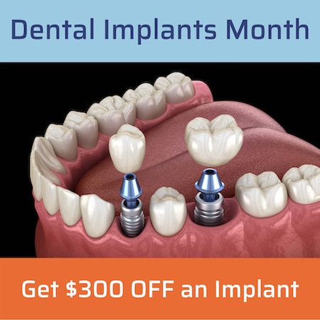 Dental Implants Offer